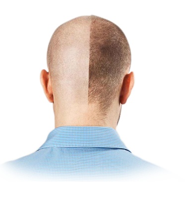 Hair Transplant