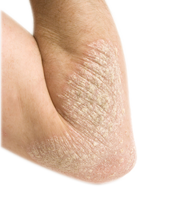 Psoriasis