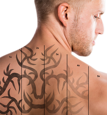 Tattoo Removal