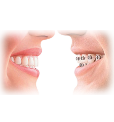 Teeth Correction and Straightening