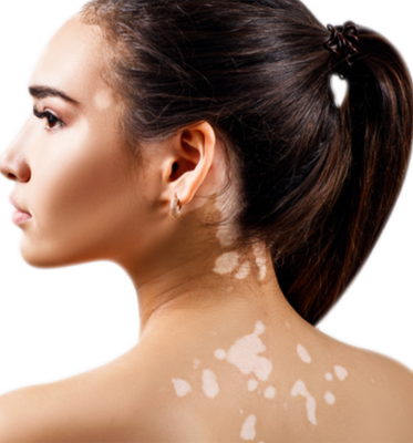 Vitiligo